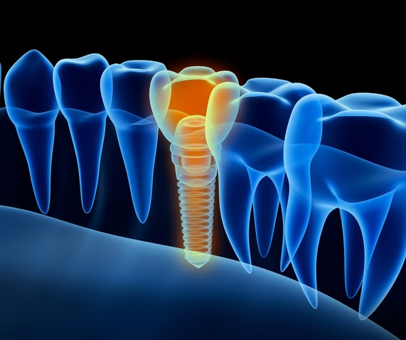 A graphic showing a dental implant