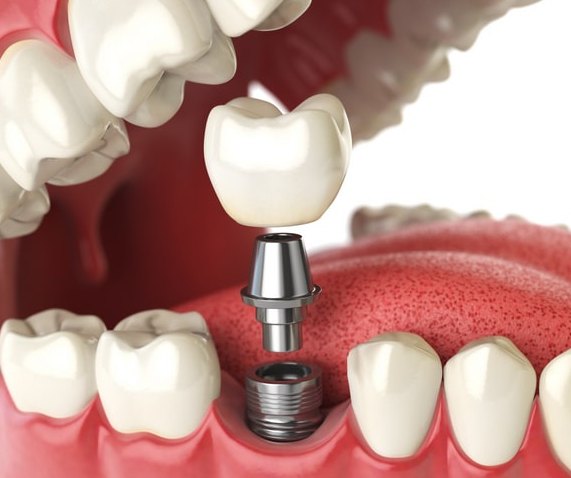 A graphic showing the components of a dental implant