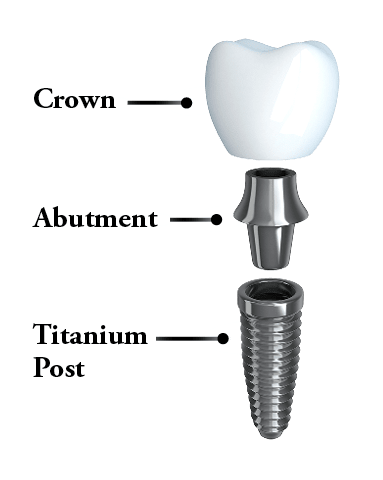 The structure of a dental implant